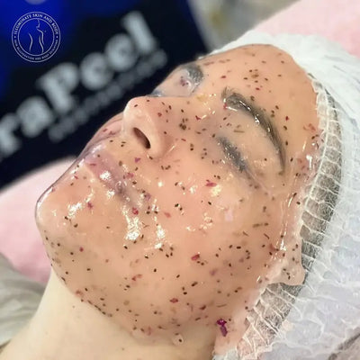 Chemical Peels