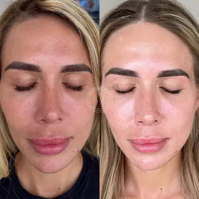 Skin Needling